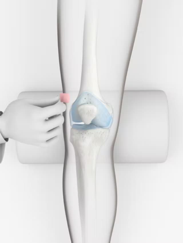 Patient walking after Arthrosamid treatment